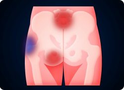 e-Xpert: Decubitus