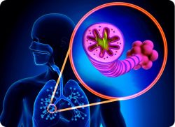 e-Xpert VVT: COPD