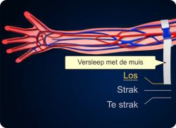 e-Xpert VBH: Intraveneuze canule/Perifeer Infuus