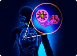 e-Xpert: COPD