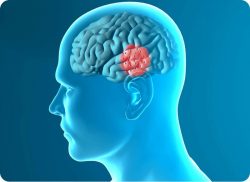 e-Xpert VVT: Parkinson