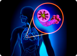 e-Xpert DA: COPD