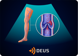 e-Xpert DEUS Echografie: Diep veneuze trombose