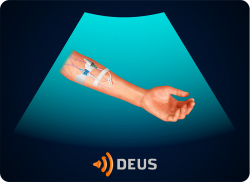 e-Xpert DEUS Echografie: Echogeleide perifere intraveneuze vaattoegang