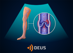 e-Xpert DEUS: Diep veneuze trombose (KNMG-GAIA)